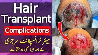 Hair Transplant Complications and Risks [upl. by Ozne896]