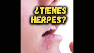 ¿TIENES HERPES 🧏🏻‍♀️ [upl. by Ameehsat814]