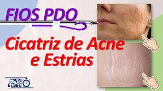 Fios PDO no tratamento de Cicatrizes de ACNE e ESTRIAS [upl. by Amat536]