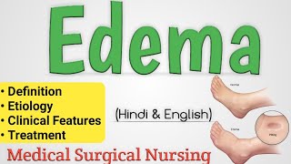 Edema  Edema In Hindi  Oedema [upl. by Cinom]