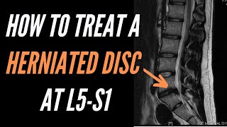 How To Treat A Herniated Disc At L5 S1 [upl. by Siri]