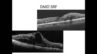 Diabetic Macular Oedema part 2 [upl. by Audie]