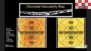 Webinar 1 Topic 7 Choroidal Imaging and Indices  DrJay Chhablani [upl. by Riannon]