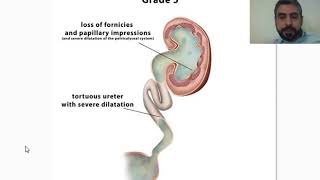 vesicoureteric reflux [upl. by Kahn]