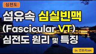 섬유속 심실빈맥fascicular VT fascicular ventricular tachycardia 심전도ecg 이해 [upl. by Jacquelynn]