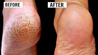 CRACKED HEELS HOME REMEDIES  HOW TO CURE CRACKED amp DAMAGED FEET  OMABELLETV [upl. by Formenti]