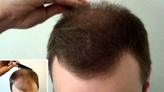 Thickening hair in frontal and top scalp [upl. by Enowtna163]