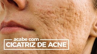 Como ACABAR com cicatrizes de acne espinhas e cravos com açafrão [upl. by Mowbray]