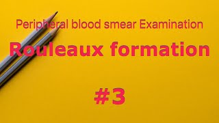 Rouleaux formation  peripheral blood smear Examination  Hematology  Multiple Myeloma ESR [upl. by Nerraw373]