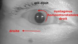 Nystagmus horizontorotatoire droit lors de la manœuvre diagnostique de DixHallpike VPPB 5ème [upl. by Sheets]