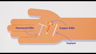 IUDs for Contraception [upl. by Scever]