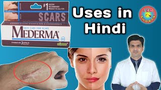 Mederma cream  mederma for acne scars  mederma advanced scar gel review [upl. by Pirozzo]