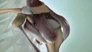 Torn Rotator Cuff Causes Symptoms amp Treatment  DePuy Videos [upl. by Florentia548]