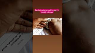 Harrisons sulcus and rachitic rosary in vitamin D deficiency hospital doctor medical [upl. by Pernell406]