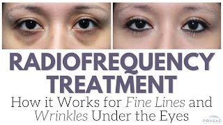 How Radiofrequency Devices Work on Fine Lines and Wrinkles and Why its Not the Only Treatment [upl. by Aierbma]