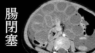 第１７回：腸閉塞 腸間膜裂孔によるclosed loopの画像診断（CT  MRI） [upl. by Atiuqaj]