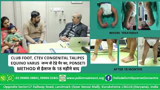 CTEV CONGENITAL TALIPES EQUINO VARUS जन्म से टेढ़े पैर का PONSETI METHOD से ईलाज के 18 महीने बाद [upl. by Yllehs]