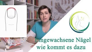 Eingewachsene Nägel wie kommt es dazu podologinandrea [upl. by Epuladaugairam915]