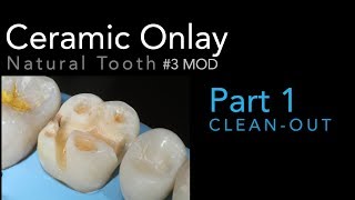 Lithium Disilicate Ceramics Part 1 Ceramic Onlay CleanOut 3 MOD [upl. by Korey]