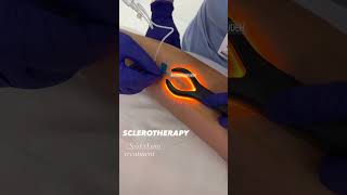 Instant Results with Sclerotherapy for Spider Veins  EDEN AESTHETICS Clinic Dubai [upl. by Saberhagen]