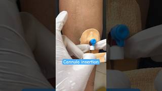 Cannula insertion of male patient nurses cannula shorts neet ytshorts youtubeshorts subscribe [upl. by Anirtik]