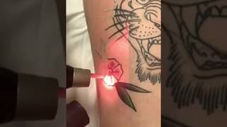 Picosure Laser The Most Advanced Laser for Tattoo Removal [upl. by Scevour]