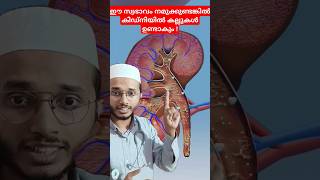 Kidney stone formation Dr Muhammed Shibili healthtips [upl. by Enalb763]