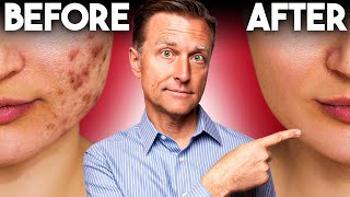 The FASTEST Way to Rid Acne  Dr Berg [upl. by Eliam911]