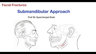 Submandibular Approach  Oral amp Maxillofacial Surgery  English  Syed Amjad Shah [upl. by Andromache]