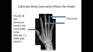 Calcinosis in Scleroderma Carrie Richardson MD MHS [upl. by Sher]