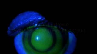 Ultracone Extreme vs Ultracone SSB in Extreme Keratoconus [upl. by Ecnerat764]