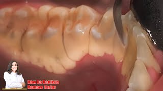 Tartar removal from teeth UNBELIEVABLY GIGANTIC TARTAR tartar and calculus Dentist Scaling [upl. by Mayrim431]