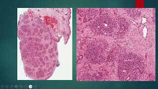 2024 09 16 Lobular Capillary Hemangioma Pyogenic Granuloma [upl. by Learrsi425]