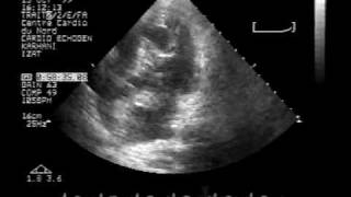 Echocardiogram Hydatid cyst in the interventricular septum apical view [upl. by Frye783]