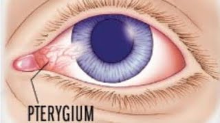 Pterygium  what is pterygium  treatment and surgery options [upl. by Atworth]