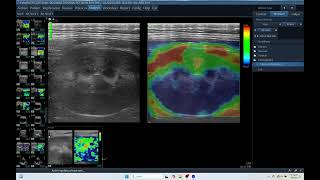 Q 179 KIDNEY ELASTOGRAPHY ECHOCARDIOGRAPHY ECHOPAC ANALYSIS [upl. by Ennoira]