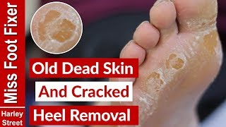 OLD DRY SKIN AND CRACKED HEEL REMOVAL BY MISS FOOT FIXER [upl. by Azmah]