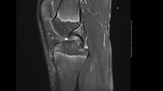 Tibial Tuberosity Apophysitis  Grade 2 Osgoods Schlatters Disease [upl. by Nalid]