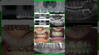 Screw Retained Fixed Ceramic DLMS CadCam Prosthesis  dentalimplantsnearme  Best Implant Center [upl. by Auqinehs]