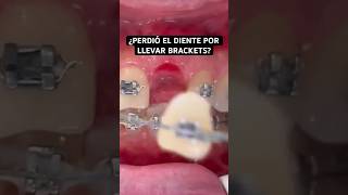 ¿Perdió el DIENTE por llevar ORTODONCIA con BRACKETS dientes [upl. by Gustafsson]