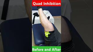 Traumatic Quad InhibitionBefore and Afterpainphysiotherapykneearthritiskneepainpainsolutions [upl. by Eirolam]