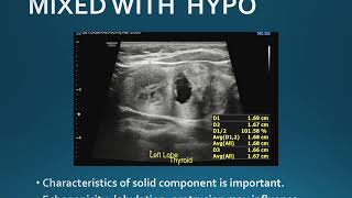 Thyroid Nodule Scoring By ACR TIRADS Mp 1 [upl. by Laikeze80]