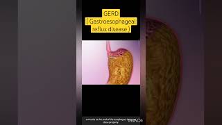 GERD  Gastroesophageal reflux disease  shortsfeed youtubeshorts medicalanimations viral [upl. by Anekam]