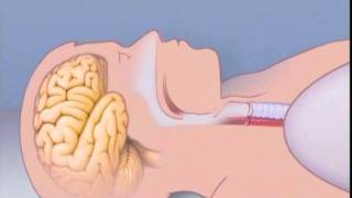 What Is Sleep Apnea [upl. by Maybelle]