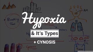 Hypoxia amp Cyanosis Causes amp PathogenesisTypes of Hypoxia Hypoxic  Anemic  Stagnant  Histotoxic [upl. by Nyrraf]