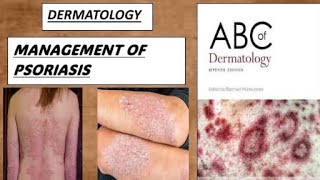 DERMATOLOGY  management of psoriasis derma psoriasis [upl. by Adriaens]