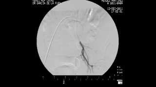 Arteriografía Renal [upl. by Batchelor]