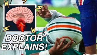 Doctor explains Tua Tagovailoa “Fencing” Response in 60 seconds TBI traumaticbraininjury science [upl. by Biondo]