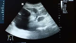 Hydronephrosis and hydroureter ultrasound examination [upl. by Rillis]