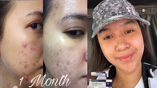 How to use Retinol for Acne  Vitamin A cream  Acretin 05 [upl. by Miahc830]